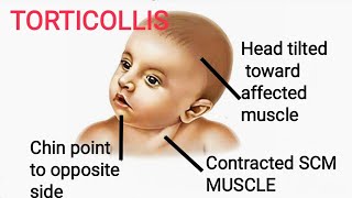 Torticollis  Clinical of Sternocleidomastoid [upl. by Aivan]