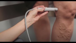 Varicose Vein Treatment amp EVLT Video by Dr Janna Bentley  Lakeshore Vein amp Aesthetics Clinic [upl. by Emoraj]