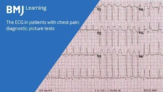 The ECG in patients with chest pain diagnostic picture tests 1 of 2 [upl. by Nisen]