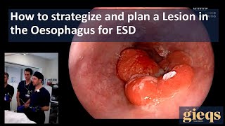 How to strategize and plan a Lesion in the Oesophagus for ESD [upl. by Sexton]