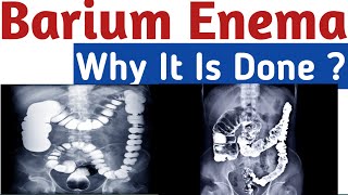 Barium Enema procedure Enema nursing fundamentals barium enema procedure video barium swallow [upl. by Kimble268]