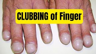 clubbing of finger [upl. by Nwatna]