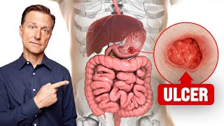 The FASTEST Way to Heal an Ulcer [upl. by Ynohtnaleahcim]