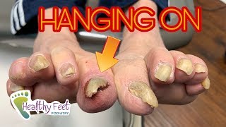 Why Its Important to Get Your Nails Trimmed Starring a Loose Nail [upl. by Hofmann]