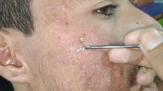 sac dep spa blackheads elderly real  sac dep spa old age blackheads 2024  sac dep spa thuy 666 [upl. by Wilkens87]