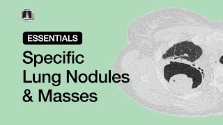 Specific Lung Nodules amp Masses  Chest Radiology Essentials [upl. by Randolph]