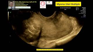 Myoma Uteri Multiple [upl. by Ettolrahs797]