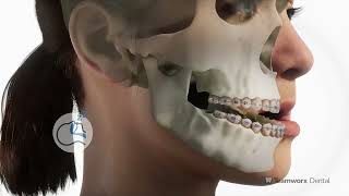 Orthognathic Surgery Underbite [upl. by Bertero]