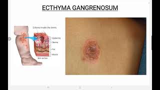 Ecthyma Gangrenosum [upl. by Marice]