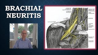 Brachial Neuritis  Parsonage Turner Syndrome [upl. by Imik]