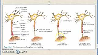 Pathology 879 e PNS PathologyPeripheral nerveWallerian degenerationperipheral neuropathy [upl. by Eilrahc]