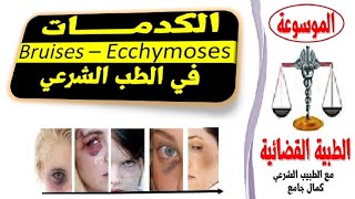 الكدمات والطب الشرعي bruises and forensic medecine [upl. by Yelrebmyk]