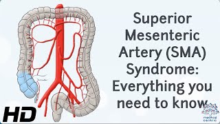 From Diagnosis to Recovery A Journey through Superior Mesenteric Artery Syndrome [upl. by Lamoree]