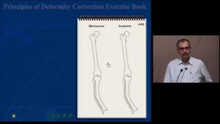 Tibial Uniapical Deformity [upl. by Ezaria]