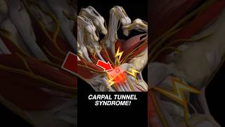 Doctor Explains CARPAL TUNNEL SYNDROME 🫴🏼💥 [upl. by Adian209]