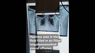 cxr radiological ground glass opacity or haziness seen in condition like pneumonitis or plueral e [upl. by Lachus]