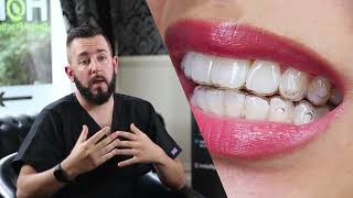 How Invisalign changes your face [upl. by Leighland996]