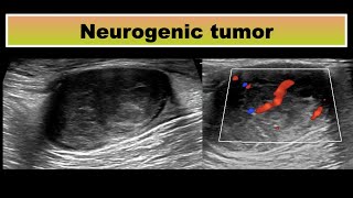 Neurogenic tumor in thigh [upl. by Emmet]