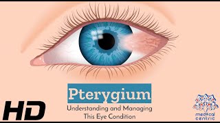 Eyes on Pterygium How to Protect and Preserve Your Vision [upl. by Racklin881]