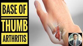 Base of Thumb Arthritis How to Diagnose [upl. by Dougy]