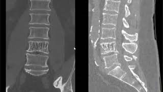 Spine lecture hemangioma of spine [upl. by Armilla824]