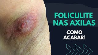 Como ACABAR Com FOLICULITE NAS AXILAS  SAIBA [upl. by Aikas]