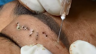 Big Cystic Acne Blackheads Extraction Blackheads amp Milia Whiteheads Removal Pimple Popping [upl. by Niabi]