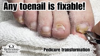 Lifted Toenail Cleaning Pedicure Transformation [upl. by Ynnob]