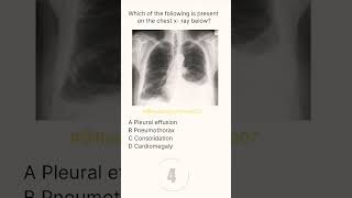 Chest XRay Buzz 7 radiologychannel007 [upl. by Damali885]