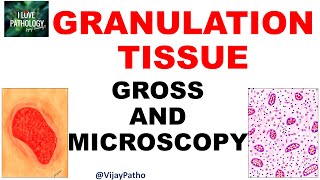 GRANULATION TISSUE  Pathology  Gross and Microscopy  Illustration  Draw With Me [upl. by Enneite342]