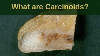 What are Carcinoid Tumours  Pathology mini tutoriaL [upl. by Nedle]