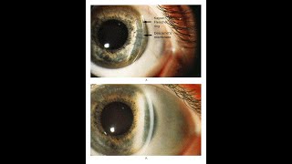 Kayser Fleischer Ring bei Patient mit Morbus Wilson [upl. by Nagey966]