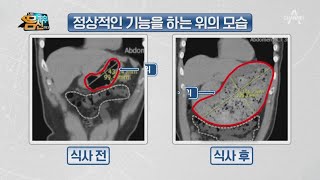 기능성 소화 불량 위가 제대로 움직이지 않으면 나타나는 증상  나는 몸신이다 354 회 [upl. by Atekin807]