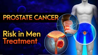 UNDERSTANDING PROSTATE CANCER  RISK FACTORS amp TREATMENT  PROSTATE CANCERPROSTATE CANCER TREATMENT [upl. by Richmound]