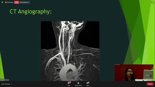 Takayasu Arteritis [upl. by Ardelia357]