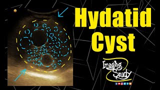 Hepatic Hydatid Cyst  Ultrasound  Case 149 [upl. by Roane]