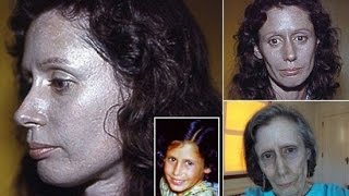 Rosemary Jacobs the Woman Whose Skin Turned Silver after Using Nose Drops [upl. by Lledniuq]