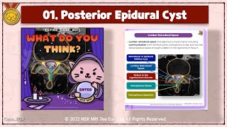 01 Epidural cysts associated with Baastrups Disease interspinous bursitis retrodural space [upl. by Nitsyrc]