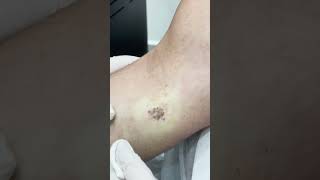 Laser Mole Removal is a Safe Quick and ScarFree Technique for Mole Removal [upl. by Otanod]