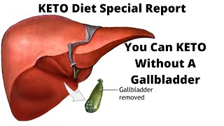 Keto diet after Gallbladder removal or cholecystectomy [upl. by Ratib880]