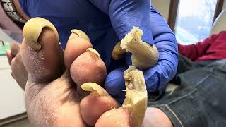 Unbelievable Toenails so long and painful that patient cannot walk [upl. by Ilellan]