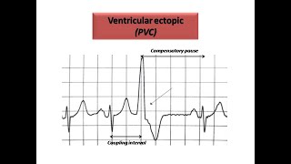 ECG course Ectopics in ECG Dr Sherif Altoukhy [upl. by Nrol]