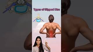 Types of slipped disc physiotherapy medicolife ytshorts physiotopics [upl. by Lud]