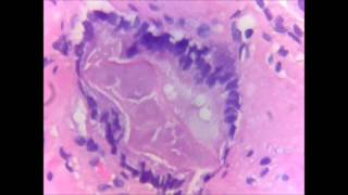 CANCER DE PROSTATA VISTO CON MICROSCOPIOadenocarcinoma acinarTinción hematoxilinaeosina [upl. by Nreval]