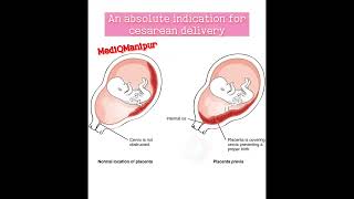 Placenta previa Cesarean sectiondoctor anatomy obstetrician nursing medicalstudent [upl. by Frederik]