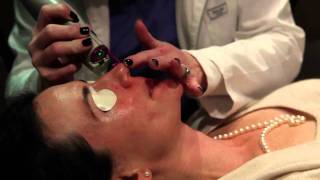 Laser treatment for Rosacea Birmingham Alabama  Cosmetic Dermatology [upl. by Adhamh]