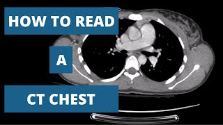 How to Read a CT Scan Chest  A Radiologists Approach [upl. by Jovi48]