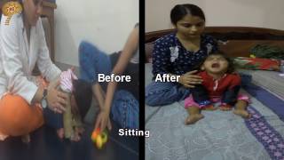 Cerebral Atrophy Treatment Results  Quick Look  No 3115 [upl. by Nesyaj]