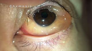 Chemosis of Conjunctiva [upl. by Hakim]