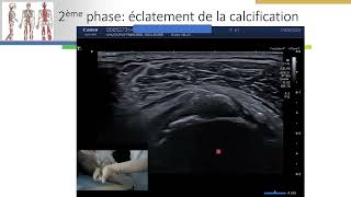 Calcification dépaule ponction lavage sous guidage échographique 2ème vidéo [upl. by Euseibbob326]